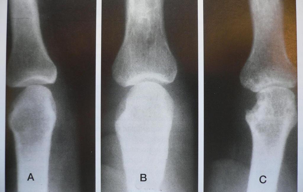 X-ray of PIP II (finger) with