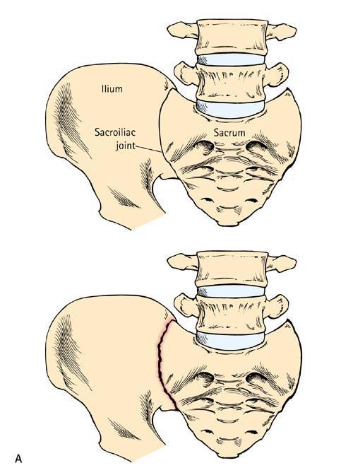 Ileosacralledd (IS-ledd)- leddet mellom nedre del av rygg og