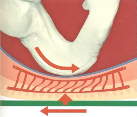 ÅRSAK Trykk Skjærende krefter er forskyvningskrefter mellom knokler og underhud.