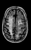 Internationale pour la Recherche et l Enseignement en Neurosciences Vaskulær demens Vaskulær demens p.g.a ischemiske forandringer (småkarsykdom) Hjerneinfarkter (slag) NINDS-AIREN*-kriteriene for vaskulær demens 1.
