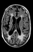 Enseignement en Neurosciences Vaskulær demens generelle trekk TIA eller hjerneslag i sykehistorien (ofte) Hypertensjon, atrieflimmer og bilyder over halskar er vanlig