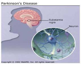 Initiativ og motivasjon Spontanitet Bevegelse Problemløsning Impuls kontroll Demens ved Parkinsons sykdom Parkinsons sykdom: 1. Tremor (hvile) 2. Rigiditet 3. Bradykinesi 4.