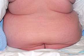 Fettevevet, et aktiv energi lager og endokrint organ Hva skjer (pato)fysiologisk når fedme utvikles?