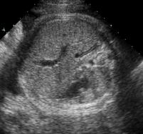 Ultrasound in Obstetrics & Gynecology Volume 39, Issue 5, pages 563-568, 26 APR 2012 DOI: 10.1002/uog.10081 http://onlinelibrary.wiley.com/doi/10.1002/uog.10081/full#fig2 LMP & BPD Estimated fetal weight; e.