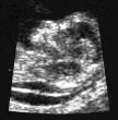 Ikke fosterdiagnostikk Fosterdiagnostikk Non-invasiv prenatal testing; cfdna Ultralyd tidlig i svangerskapet.