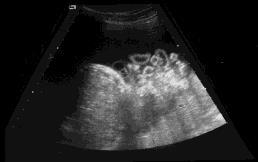Gastroschisis mode of delivery Rikshospitalet 1990-2005 Apgar 1 min Apgar 5 min Gestational age Ventilator days Cesarean n=49 6.9* 8.2 Vaginal n=16 8.0 8.8 36.1 37.1 6.0 3.