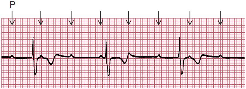 AV-blokk, grad 3 (totalblokk) Transport direkte til arytmisenter for pacemaker Kan ha behov for ekstern pacing P-frekvens: 90 /min