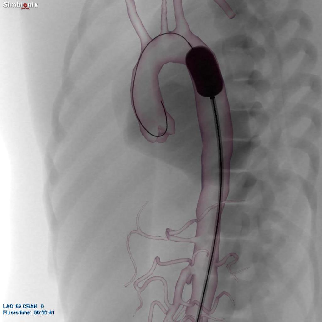 Resuscitative Endovascular Balloon Occlusion of Aorta (REBOA) REBOA er