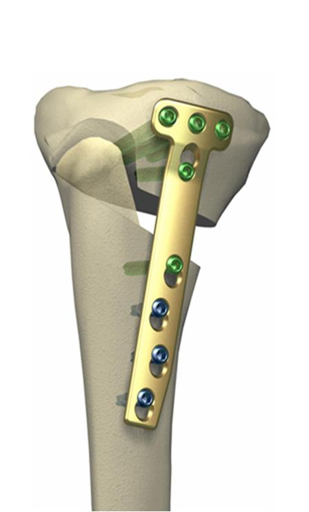 OM OPERASJONEN Operasjonen blir u ørt i spinalbedøving og i llegg får du sovemedisin e er behov. Osteotomi Når ein er hjulbeint, blir det gjort eit ku gjennom øvre delen av leggbeinet frå innsida.