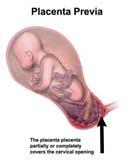 på klinisk sjokk Årsaker Placenta previa (+/- invasiv placenta)