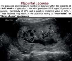 Placentære lakuner: uregelmessige og dypt i placenta Opphevet skille mellom placenta