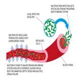 SIRS kriterier «Systemisk inflammatorisk respons syndrom» Temp > 38 C