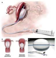 Prolonged third stage of labor: morbidity and risk factors. Obstetrics and gynecology. 1991.