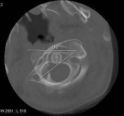 Atlantoaxial rotasjonsfiksering Traume, infeksjon, ukjent Konservativ