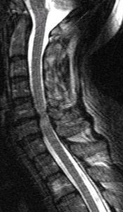 Centromedullært syndrom Klinikk Nakkeskade lett/moderat alvorlighetsgrad Svakhet i armer/hender, blære dysfunksjon Radiologi Spinal stenose m/intramedullært høysignal Etiologi: