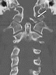 Skadetyper Øvre nakkeskader (utgjør ca 30%) Atlantooccipital dislokasjon (mors subita) Occipital condyl fraktur C1-frakturer, Jefferson fraktur Dens fraktur