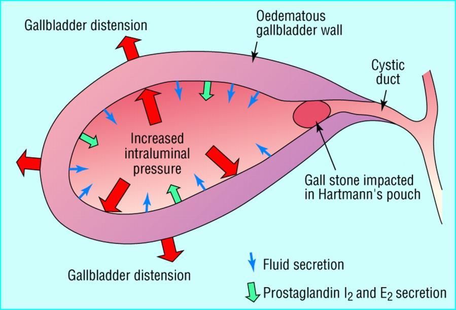 Akutt kalkuløs kolecystitt Patogenese Obstruksjon av ductus cystikus Frigjøring av inflammatoriske mediatorer