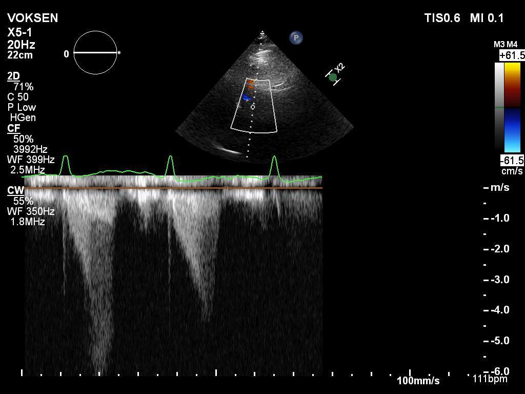 Doppler Hvile