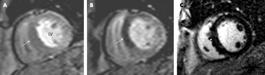 MR perfusjon Invasiv angiografi: Proximal høygradig