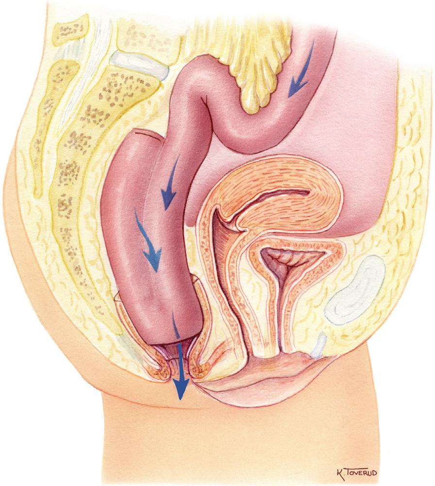 Tynntarm Livmor Oppsamlingslomme Urinblære Resten av endetarm Lukkemuskel Ileoanal anastomose IAA: Tynntarmen føres ned i bekkenet og foldes, slik at det dannes en oppsamlingslomme for tarminnhold.