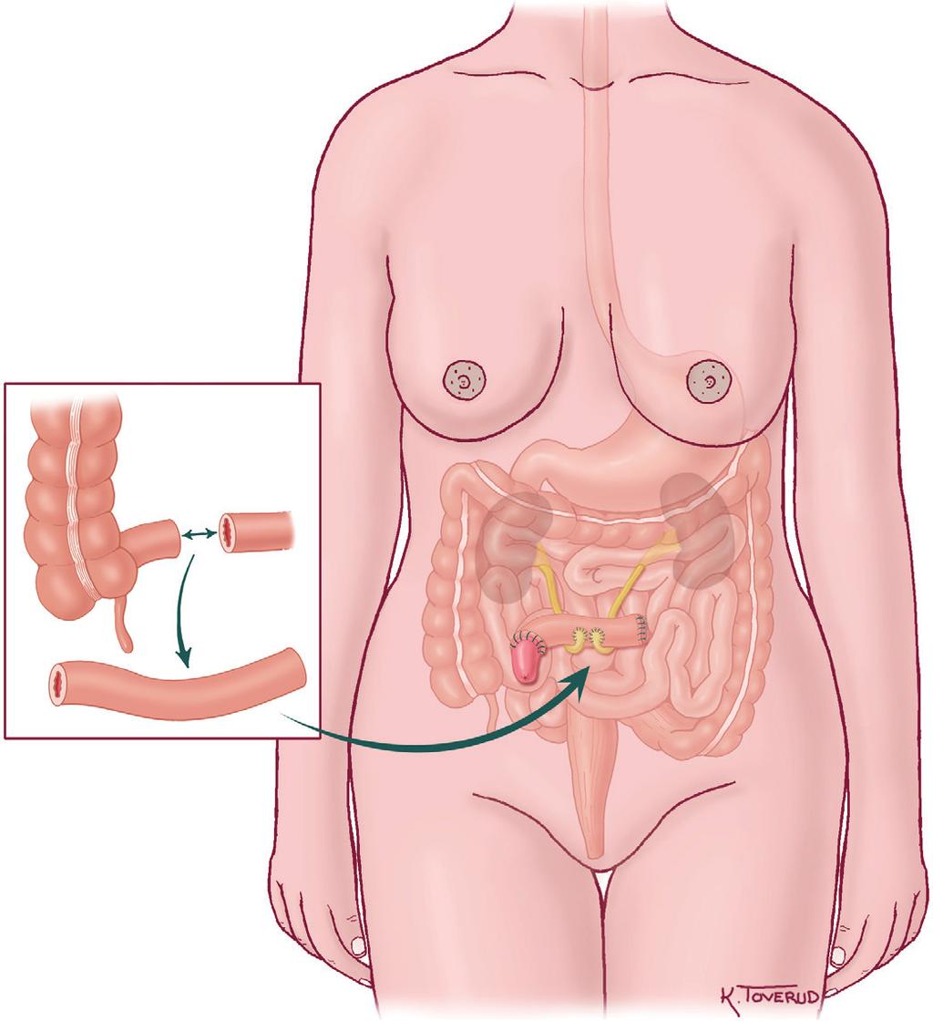 Urostomi med ileumavledning: Urinblæren er fjernet, og urinlederne er sydd inn i et stykke tynntarm, som samler opp urinen og leder den ut gjennom stomien som er anlagt i bukveggen.