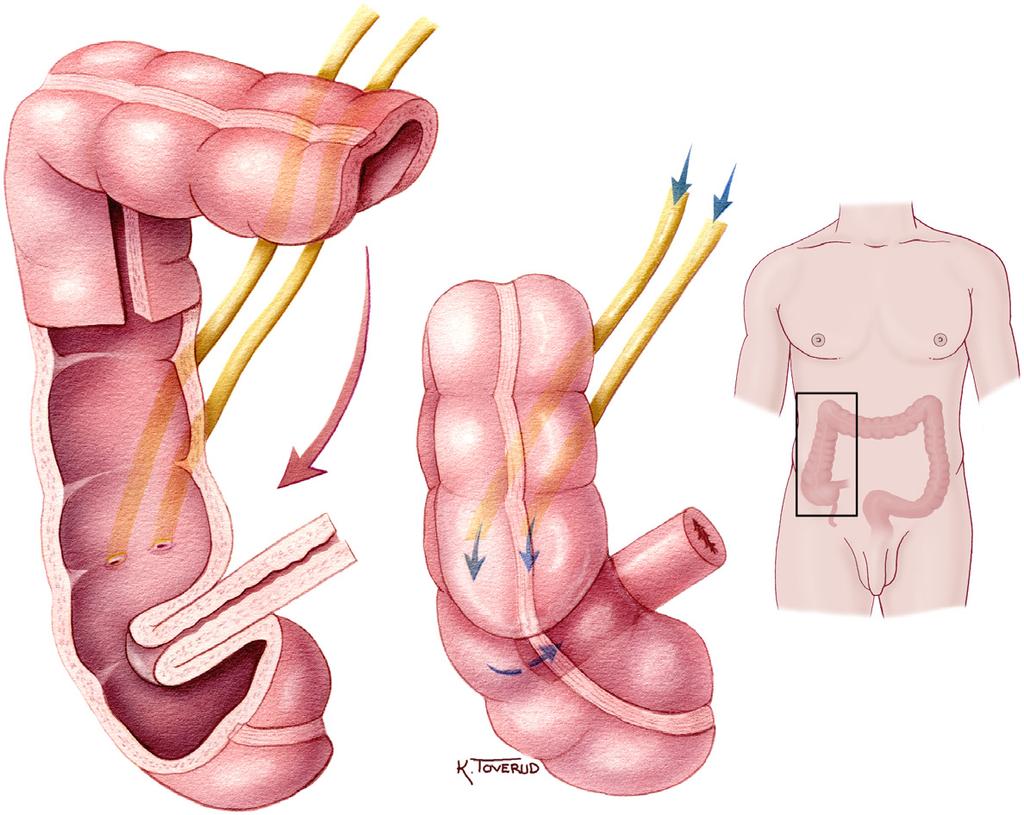 Kontinent urostomi tykktarmreservoar: Urinlederne er lagt inn i et stykke fra tykktarmen. Urinen tømmes gjennom stomien ved hjelp av et kateter.