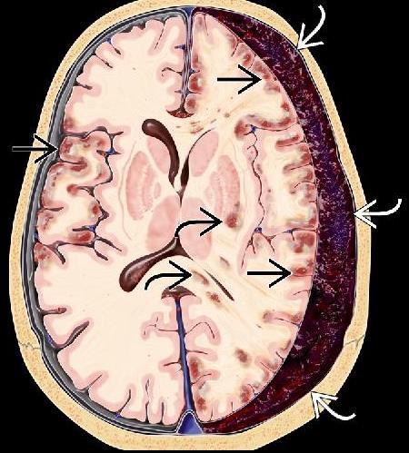Akutt subduralhematom (ASDH) og hjernen under Traumatisk hjerneødem