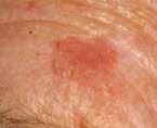 Etter hvert ser man røde, ofte flassende flekker med ujevn overflate, som gradvis kan få et mer vortelignende utseende eller oppleves som hudfortykninger.