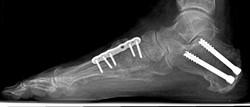 Metall i foten I de fleste operasjoner på bein er det behov for bruk av metall skruer som skal stabilisere beinet etter operasjonen.