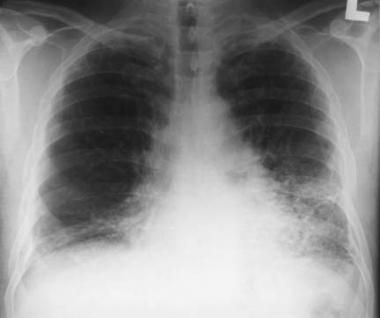 Asbestose Lungefibrose, særlig i basale deler av lungene Restriktiv