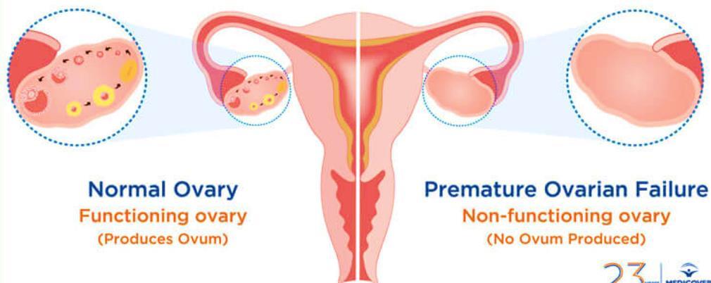 Prematur ovarieinsuffisiens (FXPOI) er
