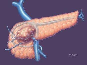 Pancreascancer 700/år i Norge Kvinner=Menn < 20 % opereres? 11.