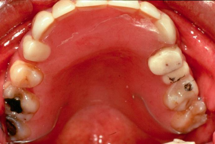 Gingivalt støttet «SYNKBAR»