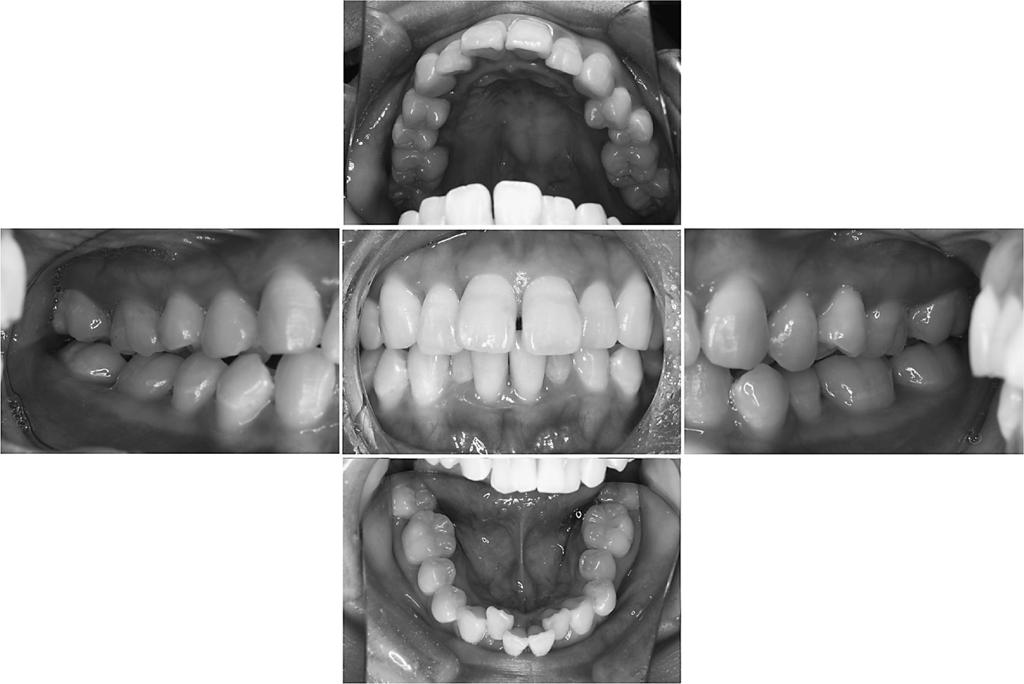 106 Irokawa D et al. Fig. 1 Oral view at baseline Introduction Periodontitis, a dysbiotic inflammatory disease, has an adverse impact on systemic health 6).