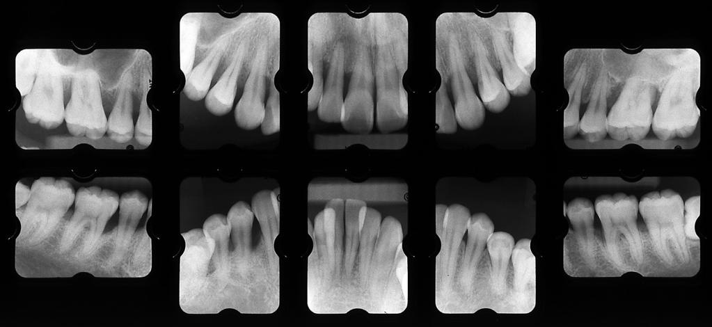 Treatment of Aggressive Periodontitis 107 Fig. 2 Periodontal examination at baseline Fig. 3 Radiographic view at baseline 1.