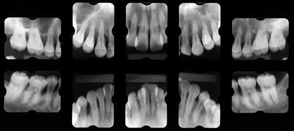 110 Irokawa D et al. Fig. 5 Oral view at 6 months during supportive periodontal therapy (SPT) Fig. 6 Radiographic view at 6 months during SPT to be suppressed even further: the count for A.