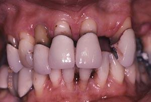 periodontitt