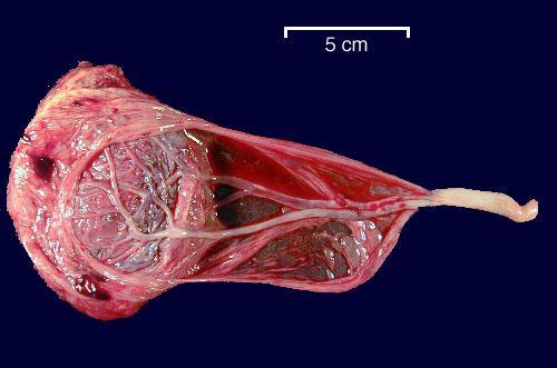 ...etter kaisersnitt Implantasjonsfeil av placenta Accreta,