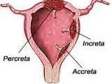Placenta accreta Økende med sektio rate, >30% in the United States Trophoblast fester seg til myometrium uten decidua Normal løsning under
