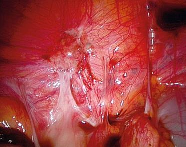 Endometriose - som et eksempel Obstetrisk og perinatal risik Varierende funn i