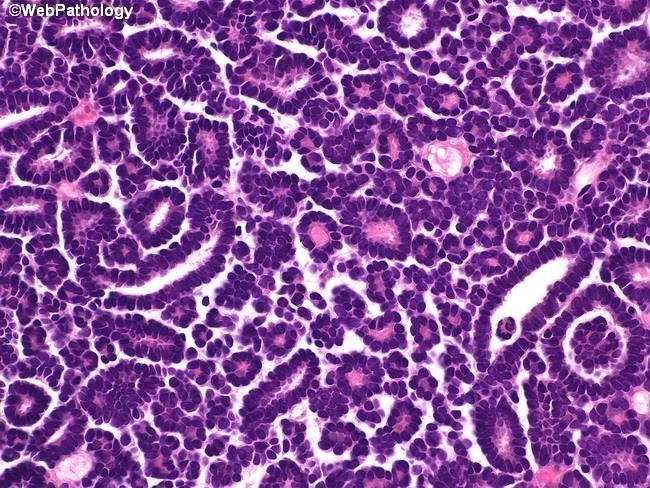 Diff.diagnoser Papillært nyrecellekarsinom