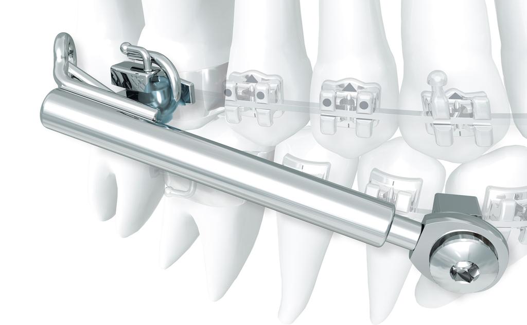 The Sabbagh Universal Spring SUS2 is a telescope appliance with an internal spring for universal intermaxillary use. It provides a perfect alternative for patients with compliance issues.