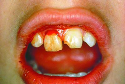 brukes. Pasienten kan også «oppbevare» tannen under tungen, men spesielt barn synes dette er vanskelig. Vanlig vann bør unngås fordi det forårsaker lyse av rotfibrene.