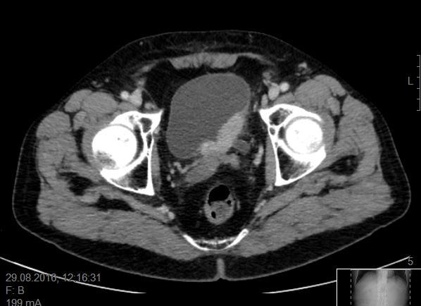 Blærekreft vist med CT i