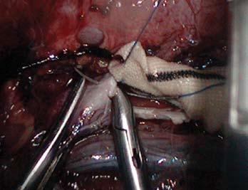 Figur 2: Laparoskopisk sutur av proximale anastonak Resultater Marc Coggia publiserte en case-control studie på 60 AAA pasienter hvor 30 var LAK(prospektivt) og 30 åpen aortakirurgi med et års