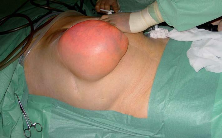 Bilde 2: Laparaskopisk for hernie i arr etter leverreseksjon mini-invasiv kirurgi 4 konvertering kan anvendes hvis ikke oversikt eller ferdigheter tillater intracorporal sutur av skadet tarm (bilde
