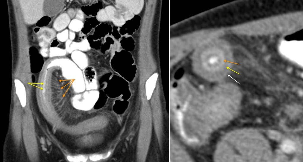 5. Radiologi Tynntarmsykdom?