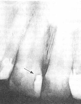 Karies? Diagnostikk av karies, forelesning 1. Er det karies tilstede? 2. Hvor stor kariesaktivitet? Tid/størrelse/lokalisasjon/utseende/progresjon salivatest, strep.mutanstest?