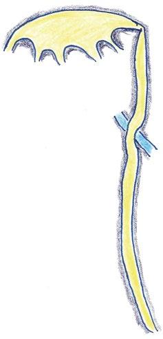 Vi tilpasset så en stram bandasje rundt pasientens buk og la ett sammenbrettet håndkle i press mellom bandasjen og høyre fossa iliaca (Figur 2). Dette hadde frapperende effekt.