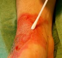 Sår/pussprøver Representativt materiale Unngå kontaminasjon fra hudens normalflora Rengjør såret Nekrose /